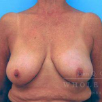Breast Reduction Case 6 Before