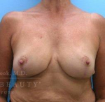 Breast Reduction Case 6 After