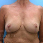 Breast Reduction Case 6 After