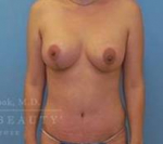 Structural Breast Surgery Case 9 After
