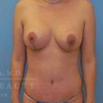 Structural Breast Surgery Case 9 After