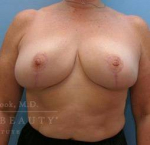 Breast Reduction Case 7 After