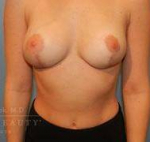 Structural Breast Surgery Case 10 After