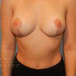 Structural Breast Surgery Case 10 After