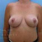 Breast Reduction Case 8 After