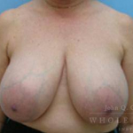 Breast Reduction Case 9 Before