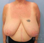 Breast Reduction Case 10 Before