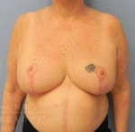 Breast Reduction Case 10 After