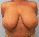 Breast Reduction Case 11 Before