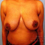 Structural Breast Surgery Case 13 Before