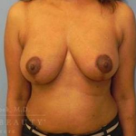 Structural Breast Surgery Case 13 After