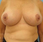 Breast Reduction Case 12 After