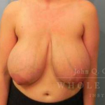 Breast Reduction Case 13 Before
