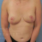 Breast Reduction Case 13 After