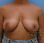Breast Reconstruction Case 1 Before