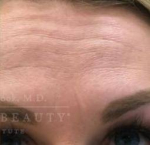 Botox Case 4 After