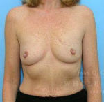 Breast Reconstruction Case 6 Before