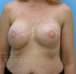 Breast Reconstruction Case 6 After