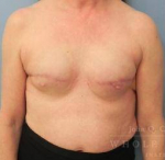Breast Reconstruction Case 10 Before