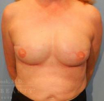 Breast Reconstruction Case 10 After