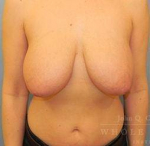 Structural Breast Surgery Case 15 Before