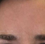 Botox Case 5 After