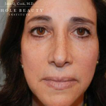 Eyelid Surgery/Brow Lift Case 3 After