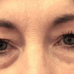 Eyelid Surgery/Brow Lift Case 5 Before