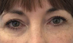 Eyelid Surgery/Brow Lift Case 5 After
