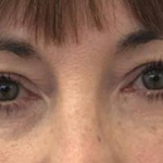 Eyelid Surgery/Brow Lift Case 5 After