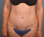 Abdominoplasty (Tummy Tuck) Case 19 After