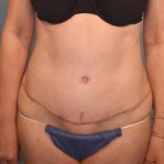 Abdominoplasty (Tummy Tuck) Case 19 After