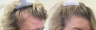 Hair Restoration Case 03 
