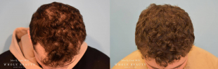 Hair Restoration Case 05 