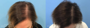 Hair Restoration Case 07 