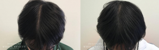 Hair Restoration Case 08 