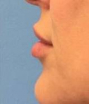 Lip Injections Case 2 After
