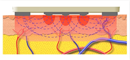 Skin Tightening Without Surgery