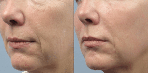 Before-After Fractora Firm