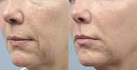 Fractora Firm at Whole Beauty Institute
