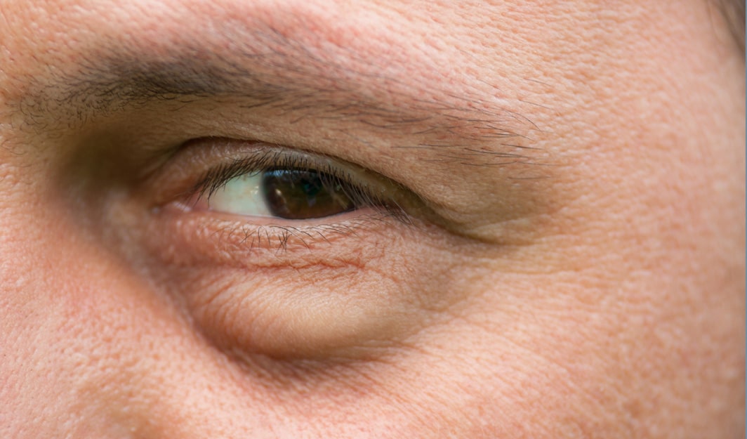 lower blepharoplasty