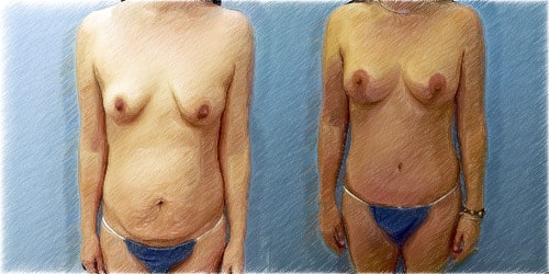 Vertical structural lift and augmentation | Dr. John Q. Cook | Chicago and North Shore