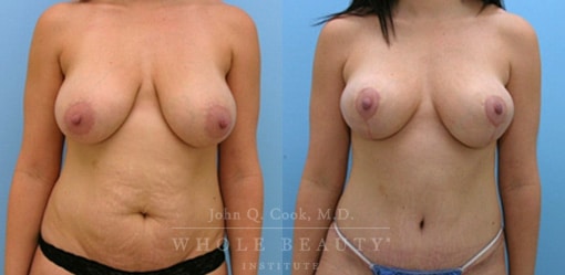 Tummy Tuck and Breast Surgery results from John Q. Cook, M.D.