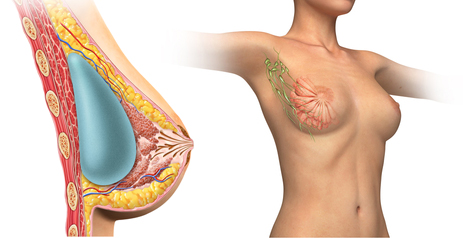 How Breast Augmentation effects the nipple and areola