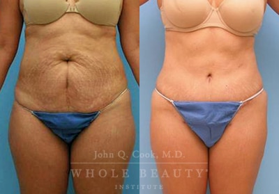 Abdominoplasty patient before and after