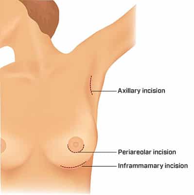 breast implant incisions, Dr. John Q. Cook breast implant incisions, Dr. John Q. Cook
