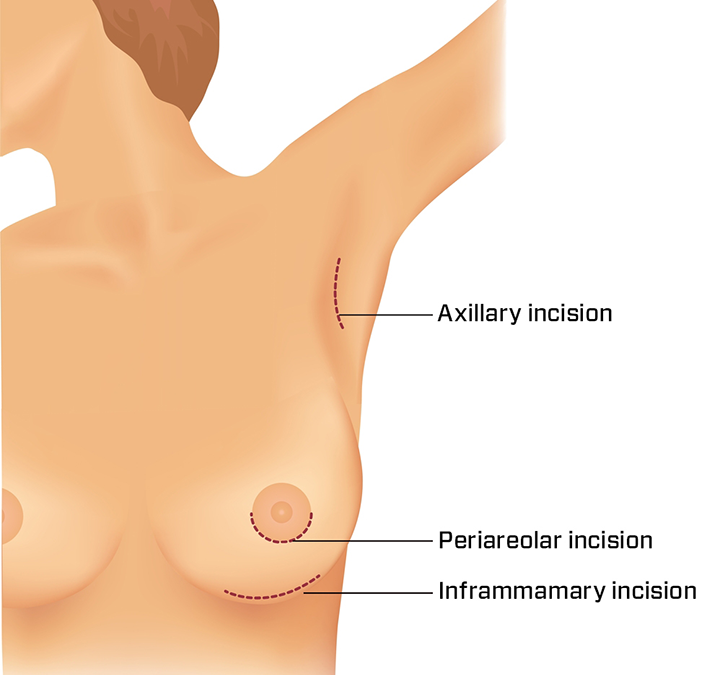Breast Implant Incisions | John Q. Cook, M.D.