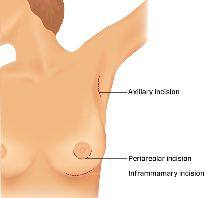 The base of the breast is important in breast implant surgery