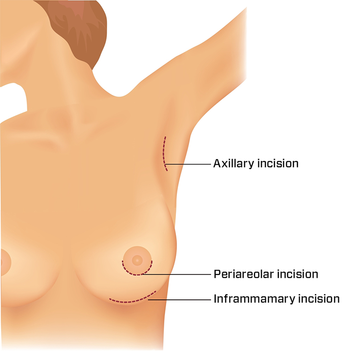 The base of the breast is important in breast implant surgery