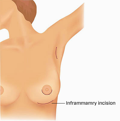 deze aanpak biedt directe toegang tot de subglandulaire, subpectorale en subfasciale vlakken, de drie locaties waar een borstimplantaat kan worden geplaatst.